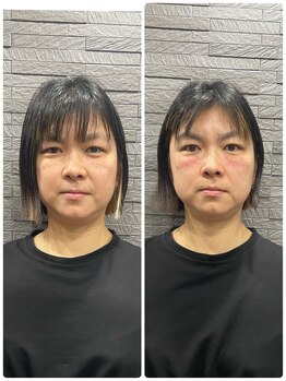 長寿鍼灸院 長寿整骨院/美容鍼50本の効果★小顔効果