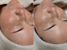 オンド(OND)/色むら、肝'斑、色'素沈'着