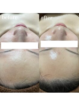 ナチュレ(Nature)/ハーブピーリングbefore→after