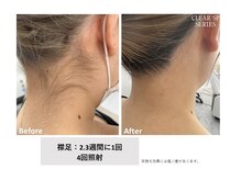 エミルカ(EMILUCA)/レディース全身脱毛