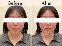 ハリラウンジ 梅田店(Hari Lounge)/美容鍼専門サロン Hari Lounge