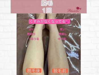 ブランリス(Blanclis)/全身脱毛☆効果