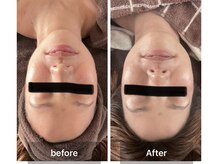 サンタ(SANTA.)/ララピール《ビフォーアフター》