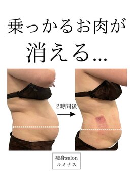 ルミナスの写真/専門機関などに頼らない、長期的な維持を考えた冷却ケア!深部脂肪へアプローチすることで痩せやすい体に♪
