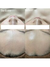 ナチュレ(Nature)/ハーブピーリングbefore→after