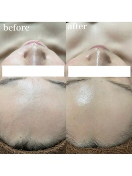 ナチュレ(Nature)/ハーブピーリングbefore→after