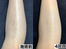 エモーショナル 姫路(Emotional)/足脱毛４回の経過【メンズ脱毛】