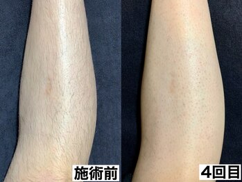 エモーショナル 姫路(Emotional)/足脱毛4回の経過【メンズ脱毛】