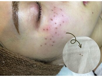 ティエル 高崎店(Tiele)/シミケア直後の様子