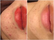 レスイズモア 恵比寿(less is more.)/10回の変化[はちみつパック付]