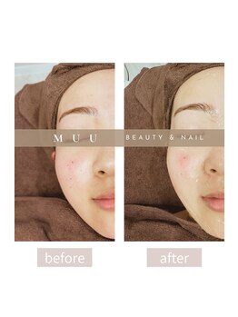 ムー(MUU)/光フェイシャルbefore＆after