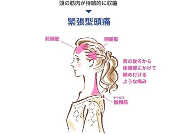 整体オガサワラ/緊張型頭痛に整体でアプローチ!