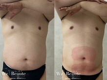 ウィボーテ(We Beaute)/【痩身】脂肪冷却×脂肪分解