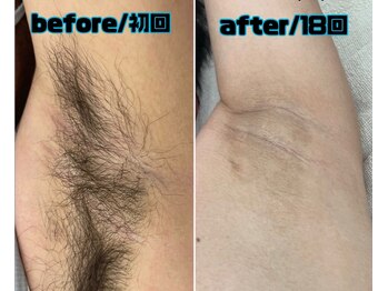 エリクサー 太田店(Elixir)/ワキ脱毛もおまかせ!