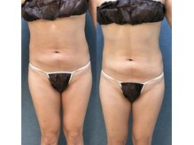 ビーホープ(B.hope)/30代産後モニター様1回目の変化