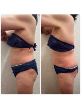 リアウェイク(Reawayke)/脂肪冷却1回目の効果