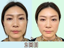 ナチュラルビューティーフェイス 横浜(NBF)/表情筋にもアプローチ/横顔小顔