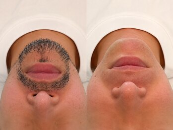 アマカ(Amaka)の写真/清潔感UP◎ヒゲ脱毛で好印象なメンズ肌へ