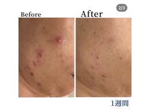 エラフリー/繰り返すニキビ☆水素で根本ケア