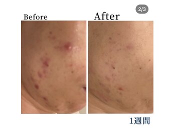エラフリー/繰り返すニキビ☆水素で根本ケア
