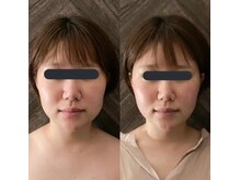 ハイコガオ(HIKOGAO)/小顔矯正40分