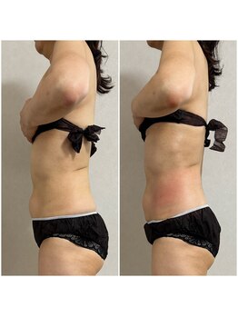 ミュウ(miuex)/背中＆お腹