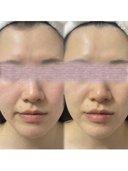 ソート(sOt)/カーボキシ―炭酸パック