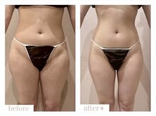 エバーグリーン(Evergreen)/脂肪冷却　各部位10回の変化