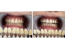 コナホワイトニング 神保町/ホワイトニング