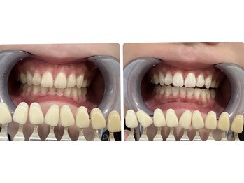 コナホワイトニング 神保町/ホワイトニング