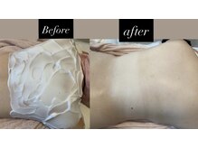 アミティエ 五反田店(Amitie)/背中　毛穴洗浄×脱毛