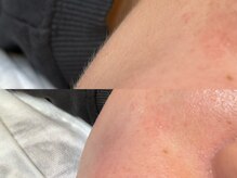 シルドゥリーナ(cil de rina)/産毛をなくして即日ツヤ肌