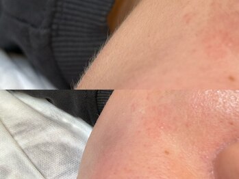 シルドゥリーナ(cil de rina)/産毛をなくして即日ツヤ肌