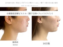 サボラミ(sabor A Mi)/DT・施術時の痛み最小限で小顔に