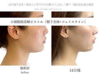 サボラミ(sabor A Mi)/DT・施術時の痛み最小限で小顔に