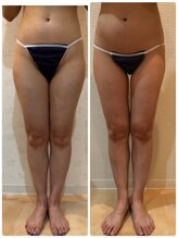 カロン(Kalon)/下半身集中痩身で長年の足太解消