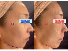 セブンシーズ 上野店(Seven Seas)/ホウレイ線・たるみ改善[東京都]