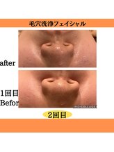 パルティノ 高崎店/毛穴洗浄フェイシャル☆