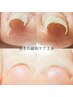巻き爪緩和ケア＜2本＞　¥8,400→¥7,900-