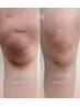 【ルメラ×ひざ】膝が美しいと“素足”が主役!黒ずみのない膝は、上品さの証!