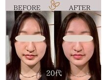 チョコバリ 新宿店(chocobari)/小顔×リフトアップ(美容鍼)20代