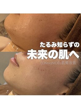 ジェノール 2nd beauty studio 姫路駅前店(JNOEL)/たるみ知らずの未来の肌へ！