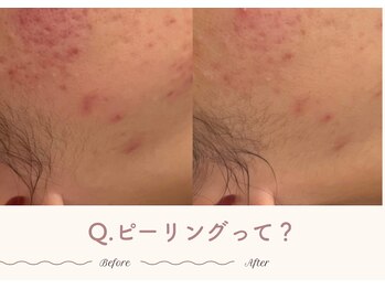 エステティックサロン シーズ/Q.ピーリングって？