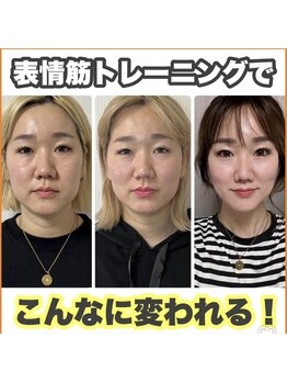 小顔になりたい