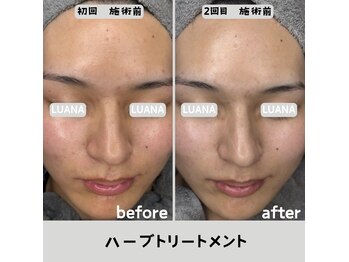 ルアナ 北谷店/ハーブピーリング 《沖縄/北谷》