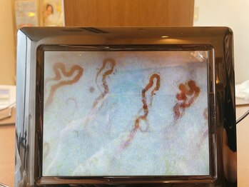 ルナスーリヤ 仙台店/カウンセリング 毛細血管