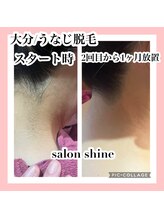サロンシャイン(Salon Shine)/うなじ脱毛の経過