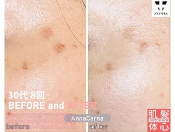 アンナカルナ(AnnaCarna)/3回から6回は続けてみて下さい