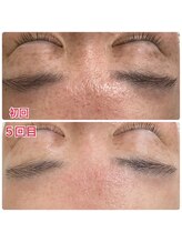 実夢(miyu)/プラズマ・ビフォーアフター