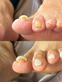 巻き爪ケアジェル